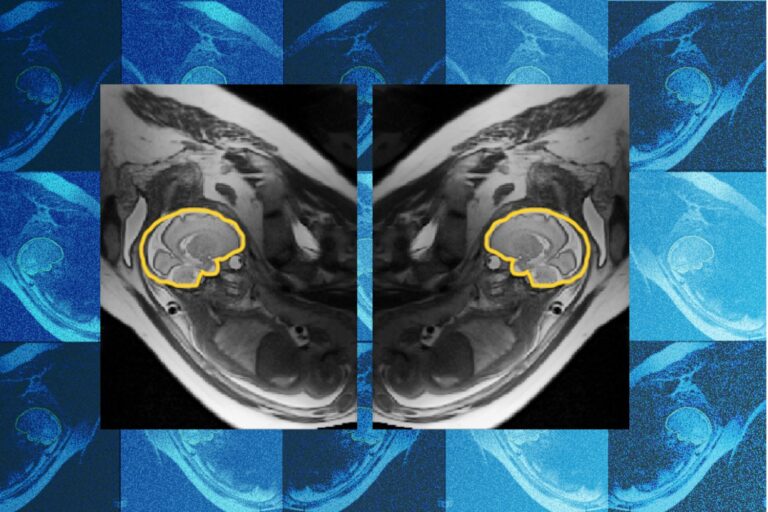 Why teaching AI about symmetry could make prenatal diagnosis more reliable | MIT News Why teaching AI about symmetry could make prenatal diagnosis more reliable | MIT News